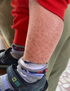 icthyosis-before