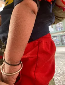 icthyosis-before1