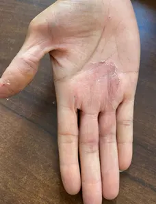 palmoplantar-after